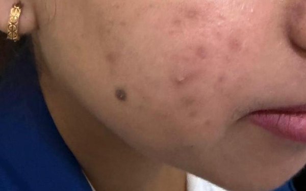Patient's cheek before treatment, showing active acne papules and dark post-inflammatory marks