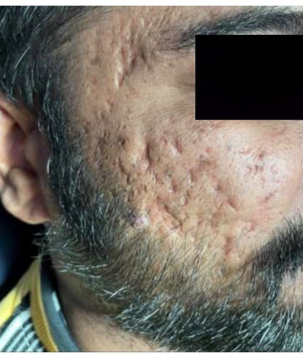 Patient's cheek before treatment, showing raised and irregular acne scarring